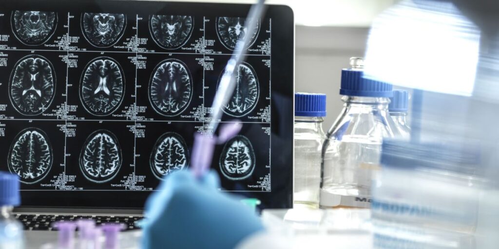 Novo tratamento pode controlar sintomas de Alzheimer, mostra estudo