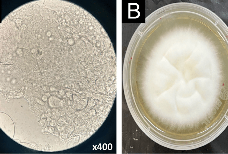 Primeiro caso de fungo super-resistente é relatado no Brasil; entenda