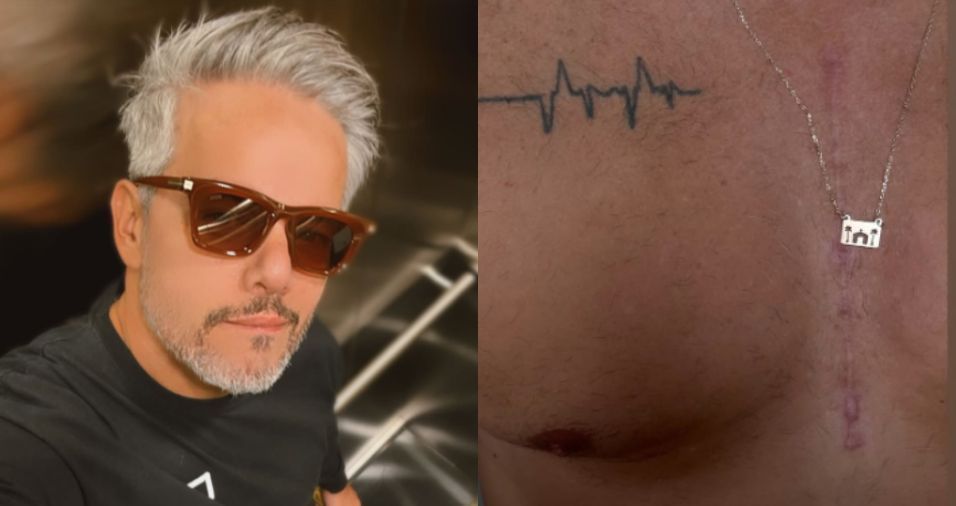 Otaviano Costa mostra cicatriz de cirurgia: "Símbolo de renascimento"