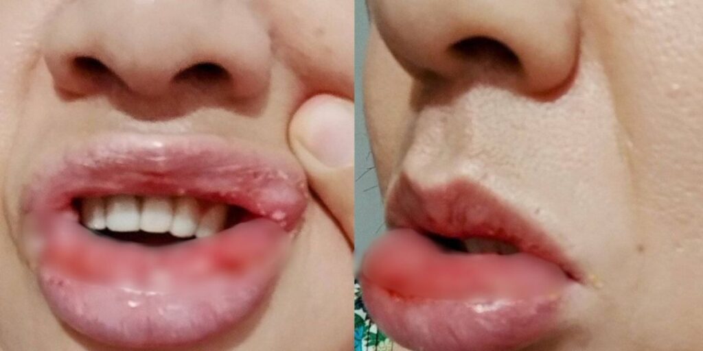 Mulher que teve lesão na boca após usar creme dental quer processar Colgate
